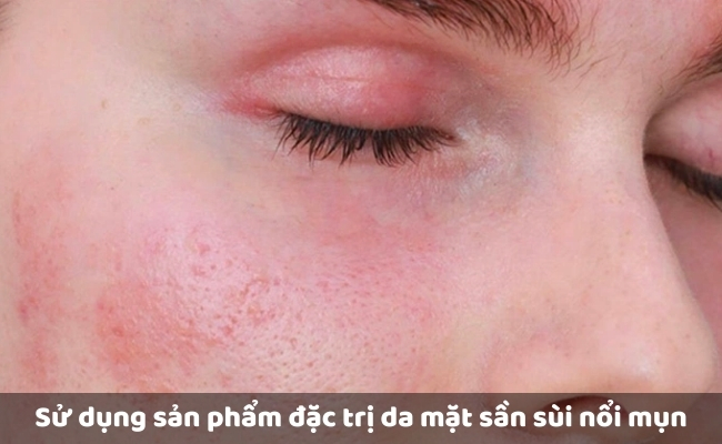 Đắp mặt nạ và sử dụng san rphaamr đặc trị da mặt sần sùi nổi mụn