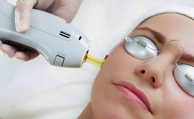 Trị mụn cám bằng liệu pháp laser YAG