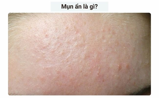 Mụn ẩn là gì?