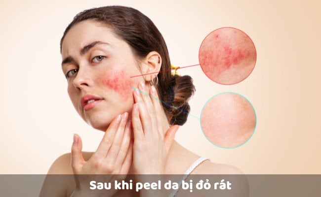 Sau khi peel da bị đỏ rát

