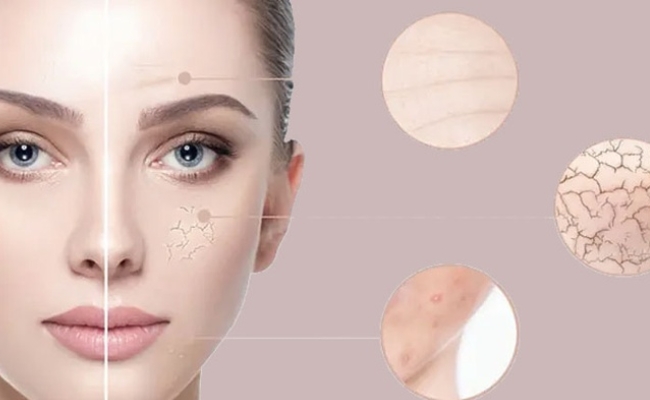 Đặc điểm của da hỗn hợp Nhận biết da hỗn hợp