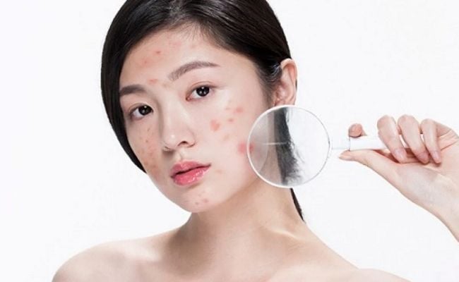 Những lưu ý giúp giảm mụn hiệu quả