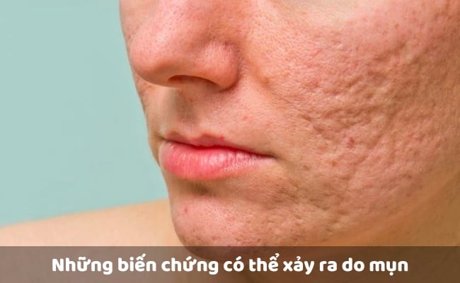 Những biến chứng có thể xảy ra do mụn