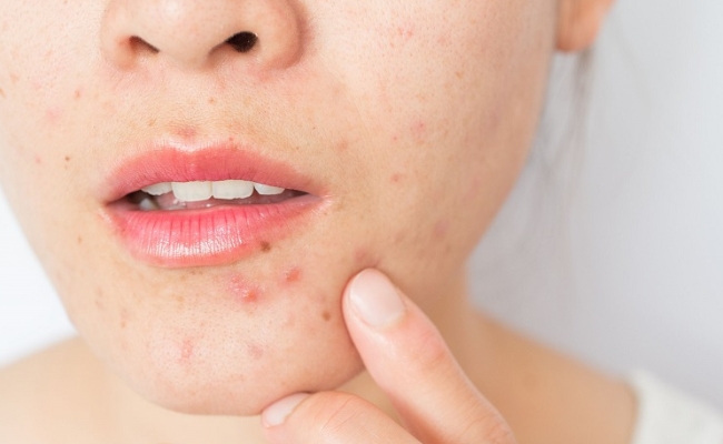 Hiện tượng bùng phát mụn có thể xảy ra khi áp dụng cách sử dụng Retinol 