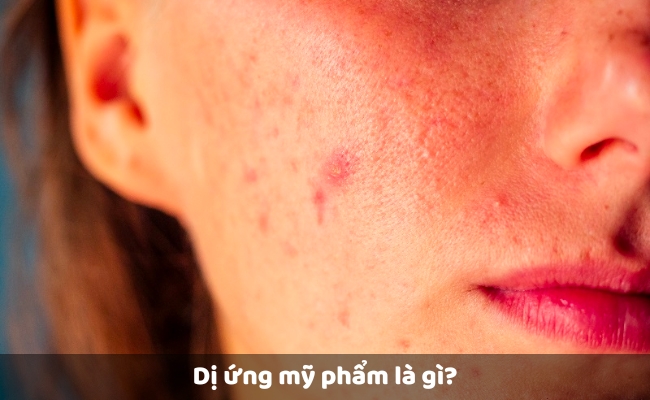 Dị ứng mỹ phẩm là gì?
