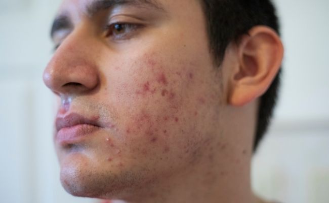 Đặc điểm làn da dầu mụn ở nam giới