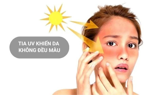 Da không đều màu do tác động của tia UV