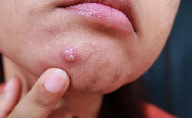 Nguyên nhân gây mụn ở từng vị trí trên mặt - Mụn ở cằm