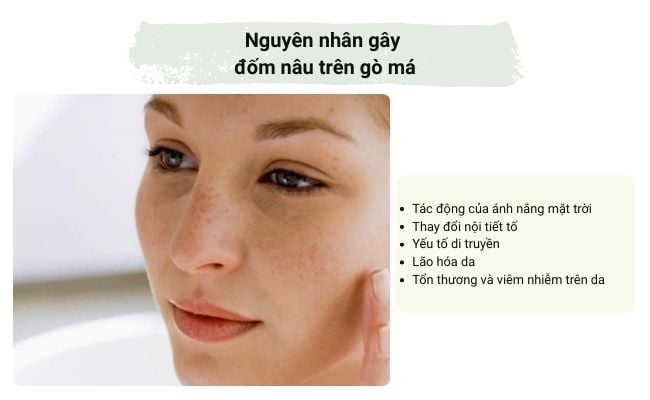 Nguyên nhân gây đốm nâu trên gò má