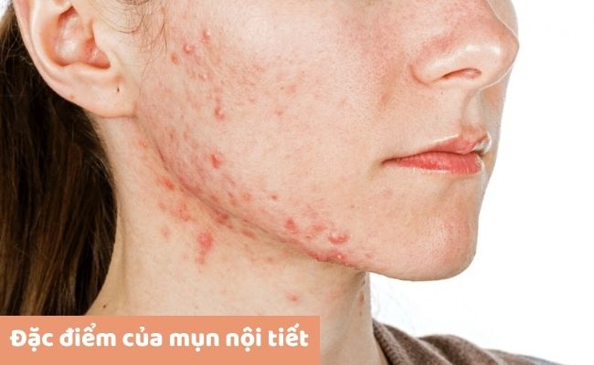 Đặc điểm của mụn nội tiết