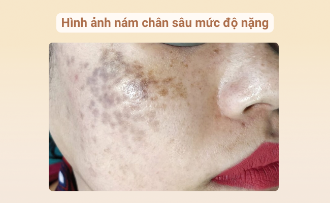 Nám chân sâu mức độ nặng
