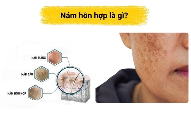 Nám hỗn hợp là gì?
