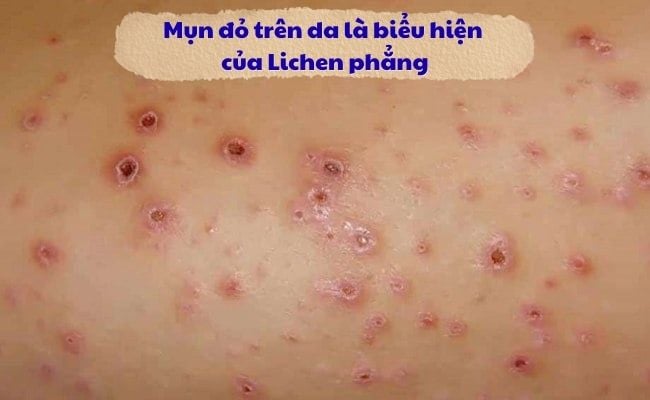 Mụn đỏ trên da là biểu hiện của Lichen phẳng