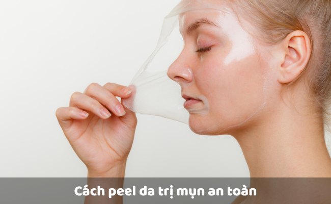 Cách peel da trị mụn an toàn