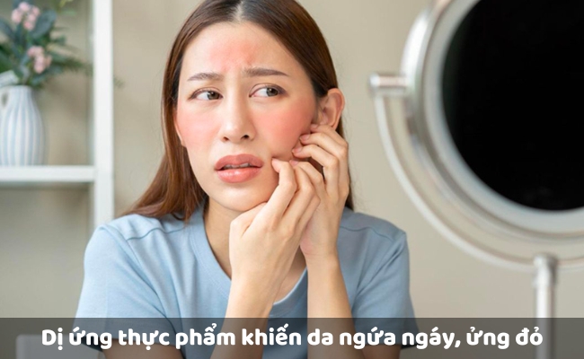 Dị ứng thực phẩm khiến da ngứa ngáy, ửng đỏ