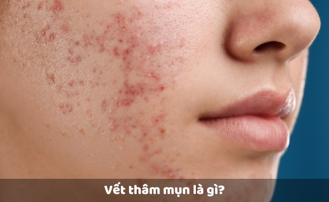 Vết thâm mụn là gì?