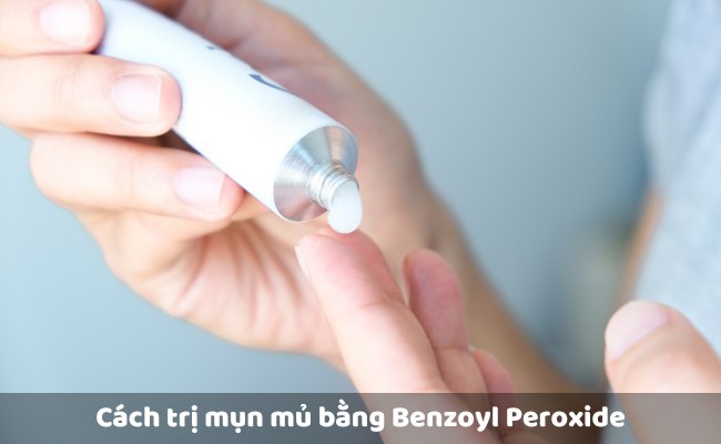 Trị mụn mủ bằng Benzoyl Peroxide

