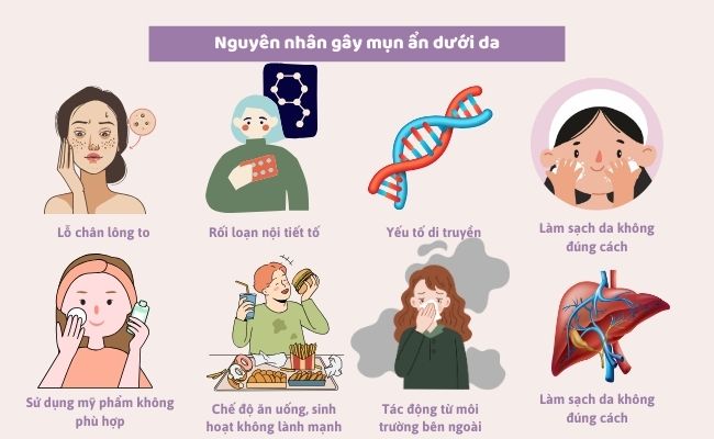 Nguyên nhân gây ra mụn ẩn