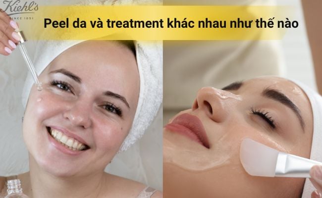 Peel da và treatment khác nhau như thế nào