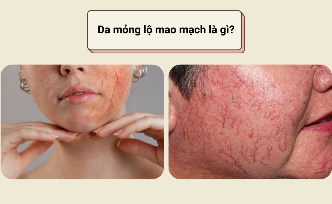 Da mỏng lộ mao mạch là gì?