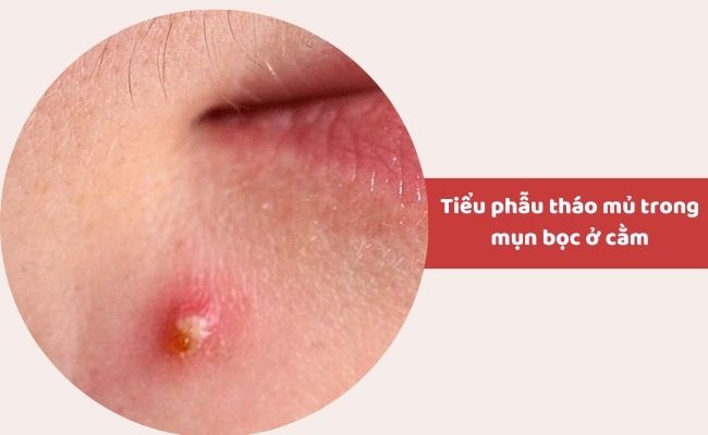 Trị mụn bọc ở cằm bằng liệu pháp y tế