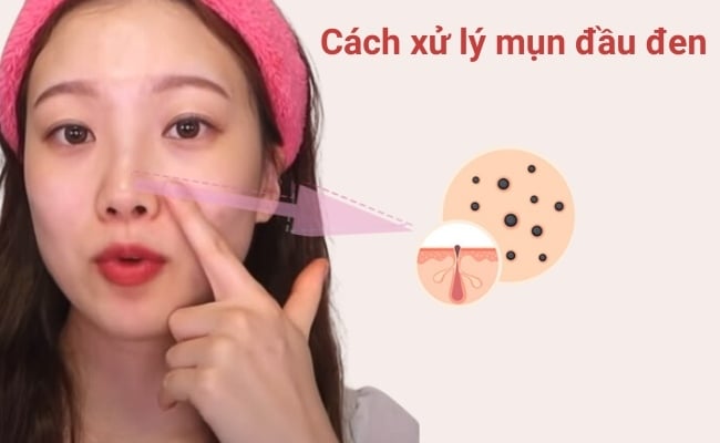 Cách xử lý mụn đầu đen