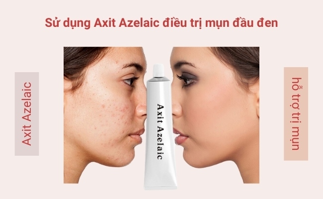 Sử dụng Axit Azelaic điều trị mụn đầu đen