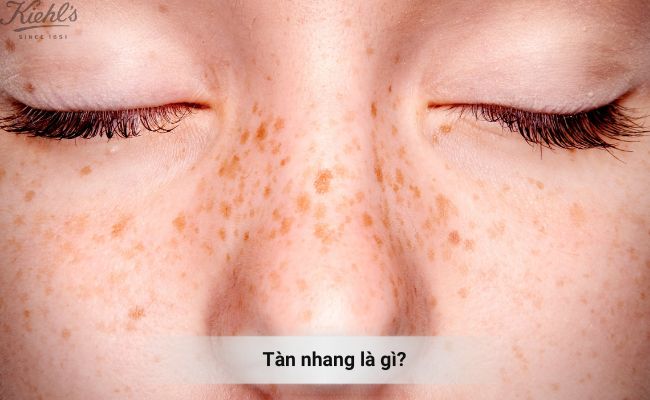 Tàn nhang là gì? Vì sao nên đốt tàn nhang?