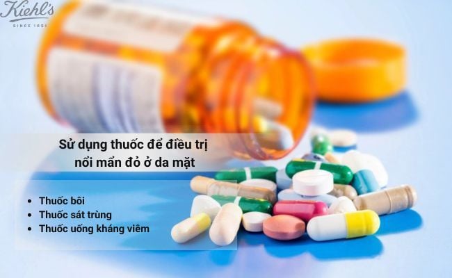 Sử dụng thuốc để điều trị nổi mẩn đỏ ở da mặt