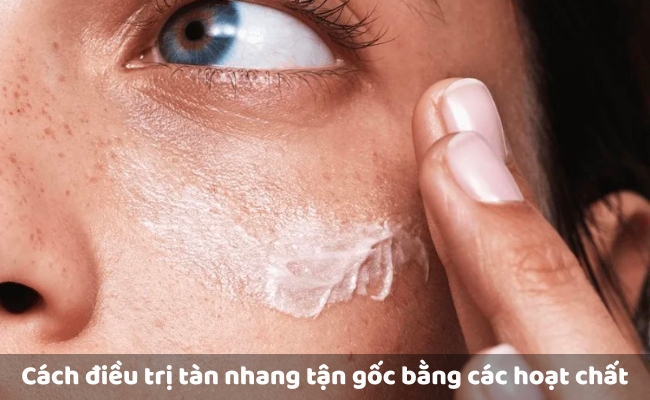 Cách điều trị tàn nhang tận gốc bằng các hoạt chất