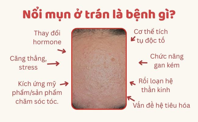 Nổi mụn ở trán là bệnh gì?