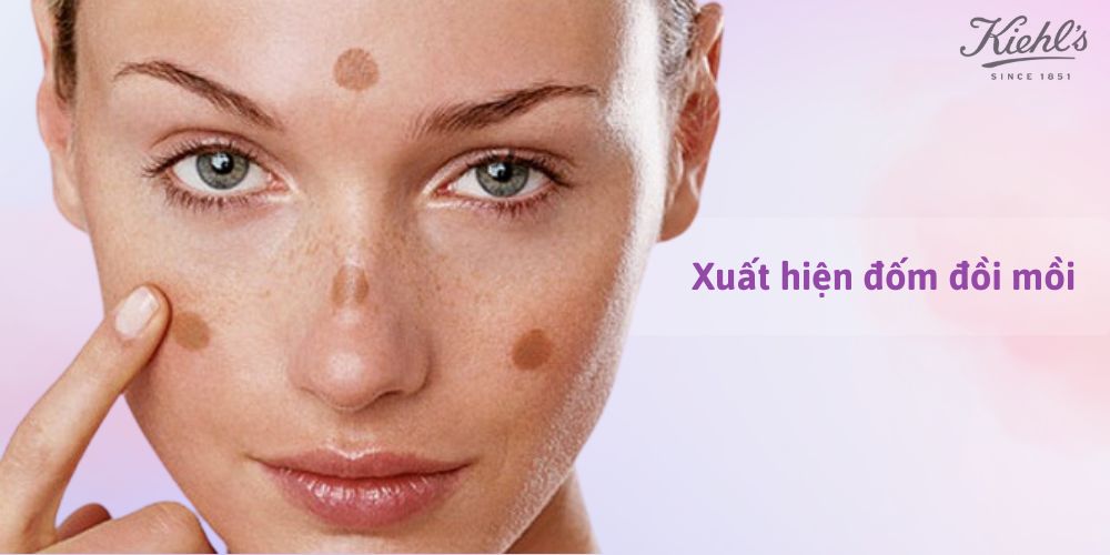 14 dấu hiệu lão hóa da thường gặp