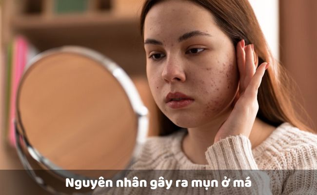 Nguyên nhân gây ra mụn ở má