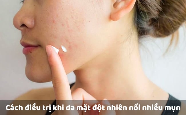 Cách điều trị khi da mặt đột nhiên nổi nhiều mụn