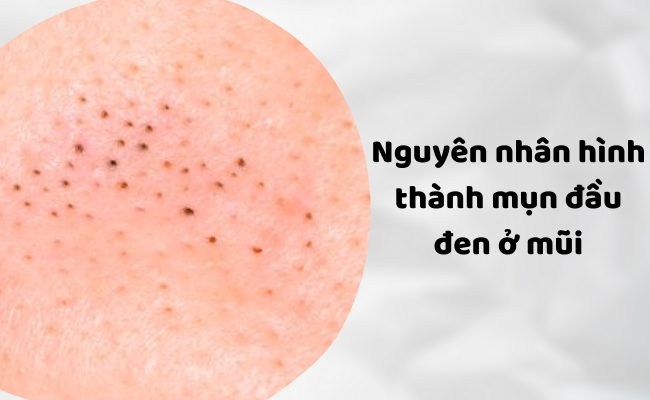 Nguyên nhân hình thành mụn đầu đen ở mũi do đâu?