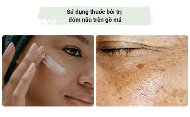 Sử dụng thuốc bôi trị đốm nâu trên gò má