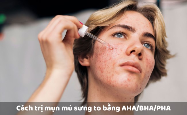 Cách trị mụn mủ sưng to bằng AHA/BHA/PHA

