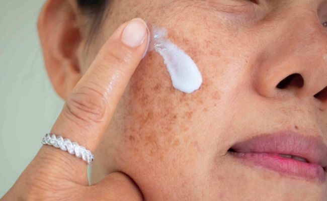 Bôi thuốc đặc trị để cải thiện tình trạng tăng sắc tố trên da mặt