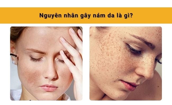 Nguyên nhân gây nám da