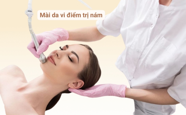 Mài da vi điểm trị nám da hiệu quả nhanh chóng