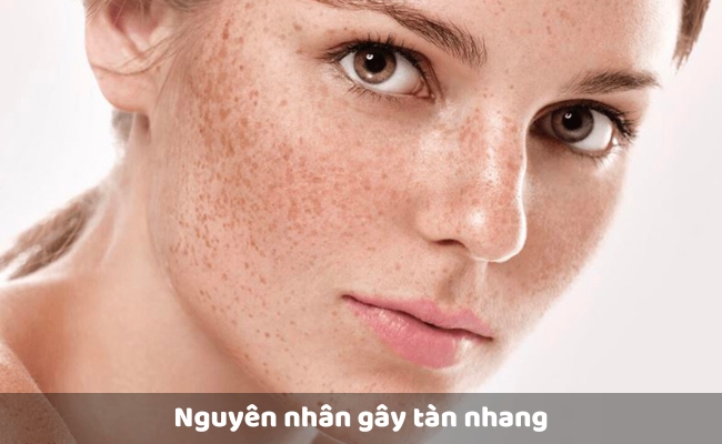 Nguyên nhân gây tàn nhang