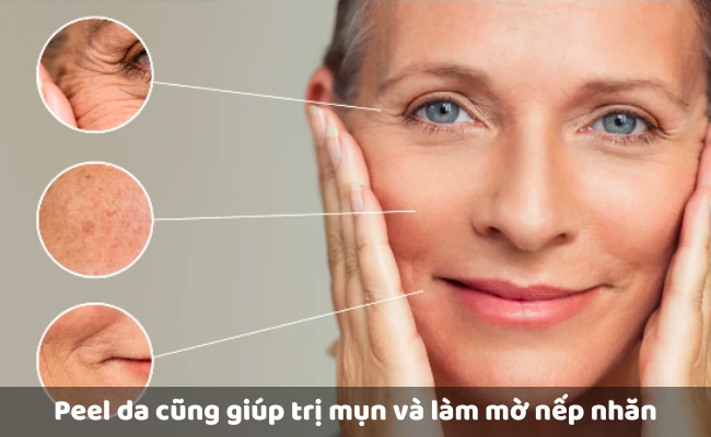Lợi ích khi peel da trị thâm - Hỗ trợ cải thiện các vấn đề da khác