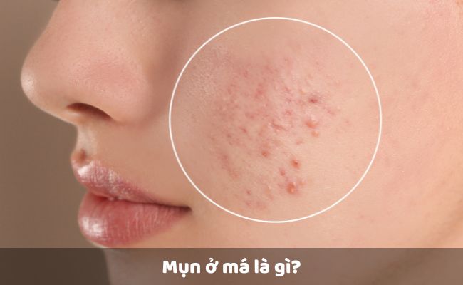 Mụn ở má là gì?