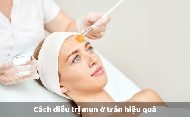Peel da trị mụn ở trán


