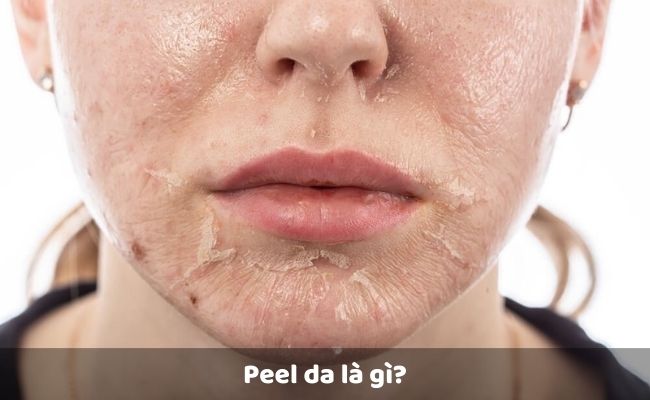 Peel da là gì?

