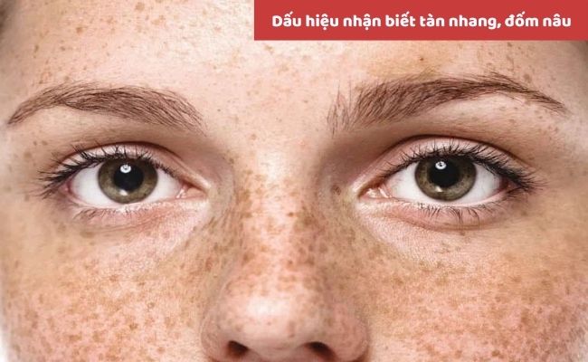 Dấu hiệu nhận biết tàn nhang, đốm nâu