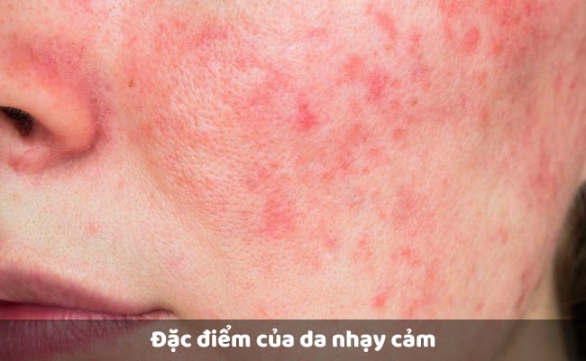 Đặc điểm của da nhạy cảm