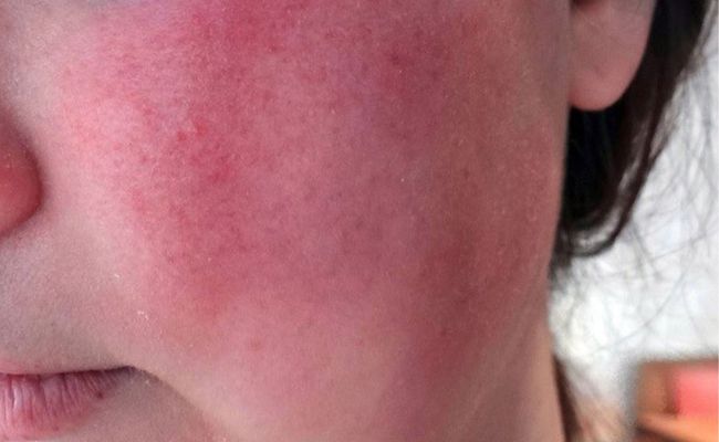 Lỡ ăn những loại thực phẩm cần kiêng sau nặn mụn thì phải làm sao?