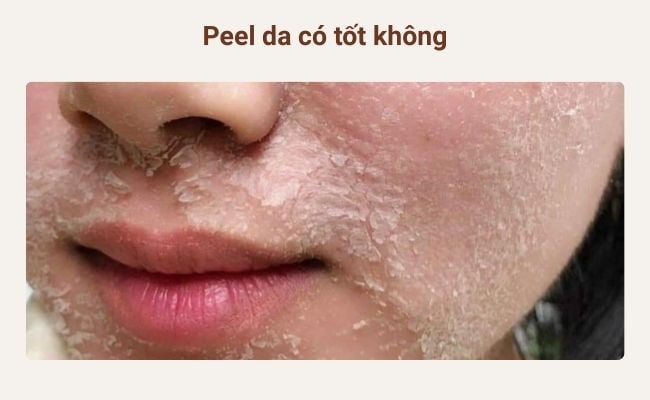 Peel da có tốt không? Tác dụng của peel da
