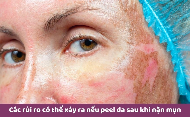 Các rủi ro có thể xảy ra nếu peel da sau khi nặn mụn